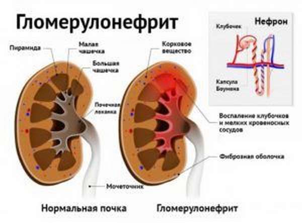 Гломерулонефрит