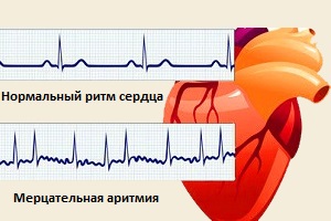 Мерцательная аритмия