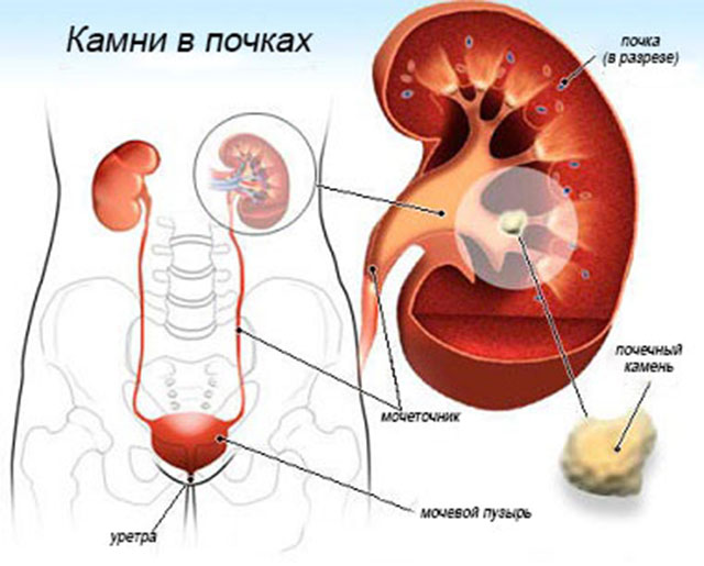 Камни в почках