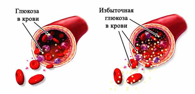 Повышенная глюкоза