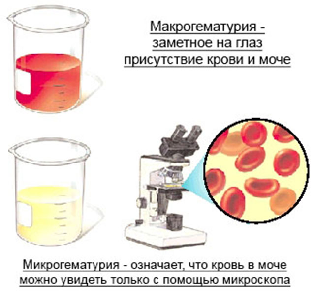 Макрогематурия, микрогематурия