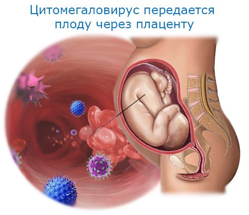 Особенно опасно заражение во время беременности