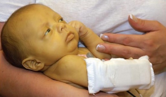 Врожденная гемолитическая желтуха у новорожденного