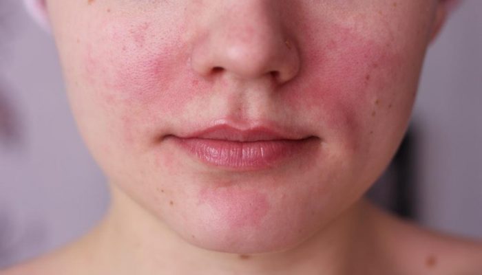Почему шелушится и чешется лицо? Основные причины зуда кожи и методы лечения