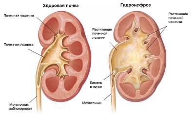 Заболевания почек с уплотнением чашечно лоханочной системы фото