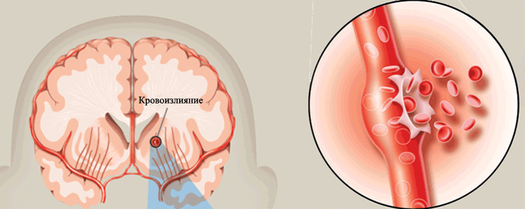 Инсульт с кровоизлиянием