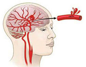 Инсульт с кровоизлиянием: последствия и лечение
