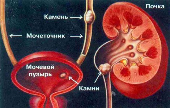 Камни в мочевом пузыре и почках