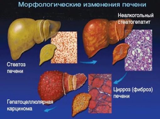 Морфологические изменения печени