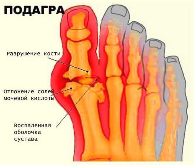 Отложение солей