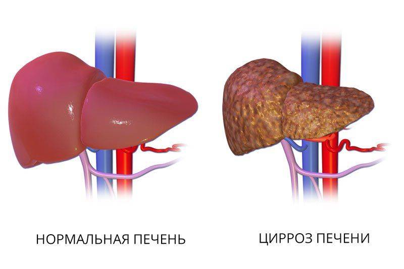 Нормальная печень и печень, пораженная циррозом