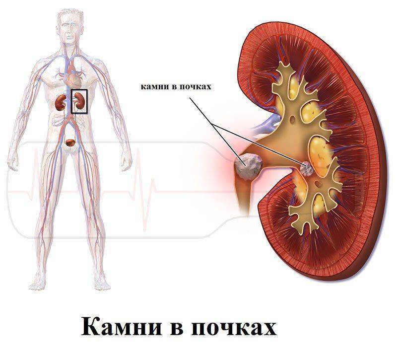 Проявление мочекаменной болезни