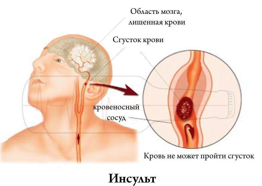 Признаки инсульта