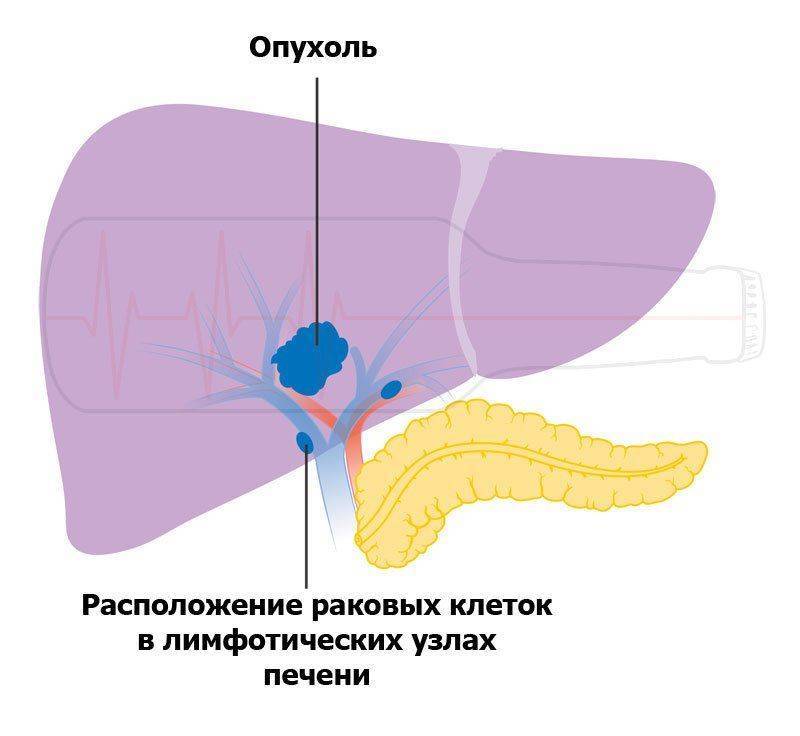 Схема рака печени