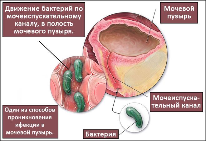 Лечение заболевания мочевого пузыря