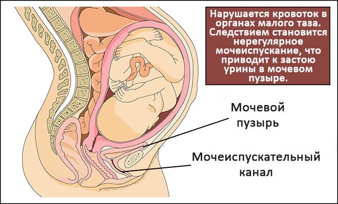 Застой мочи