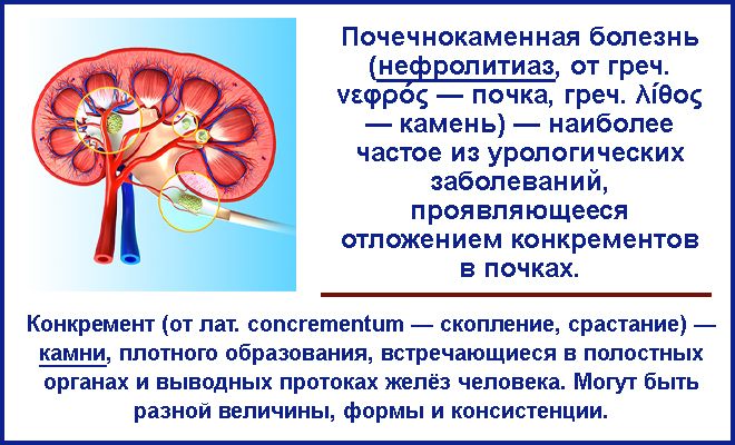 нефролитиаз