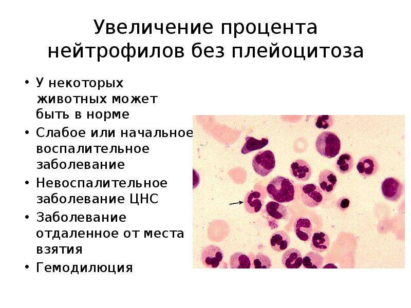 Нейтрофилы понижены причины. Нейтрофилы в спинномозговой жидкости. Полисегментация нейтрофилов. Уменьшение нейтрофилов в крови.