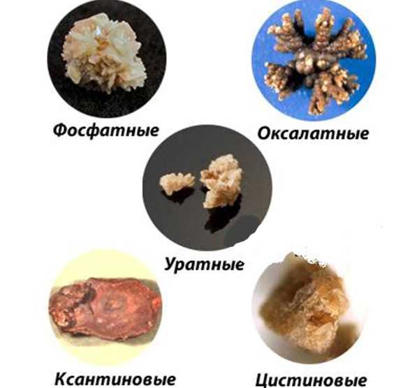 Виды камней в почках