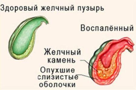 Воспаление желчного пузыря: симптомы