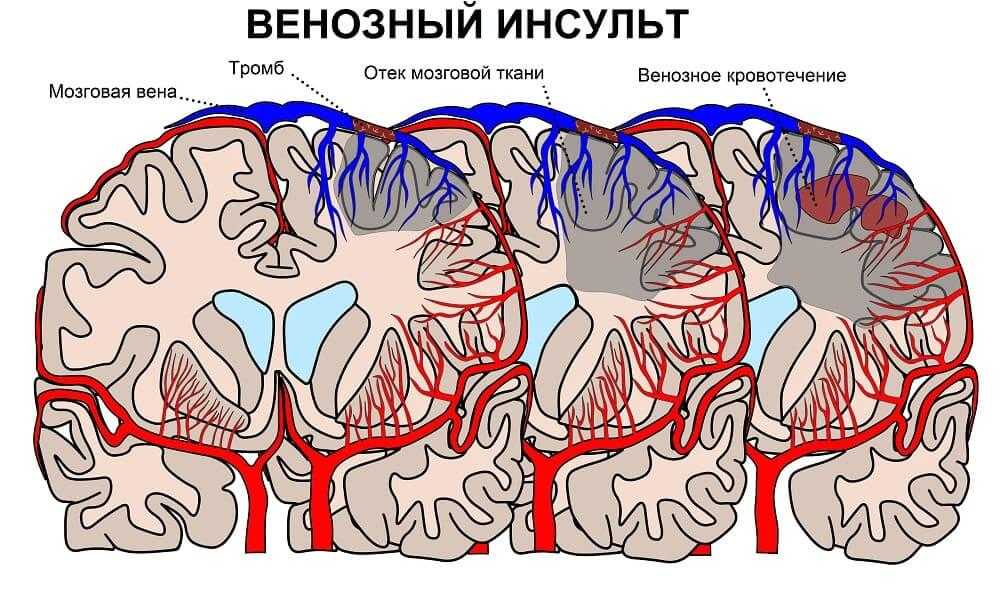 Тромб после инсульта. Венозный ишемический инсульт на кт. Синус тромбоз головного мозга. Венозный инфаркт головного мозга кт. Венозный инсульт головного мозга.