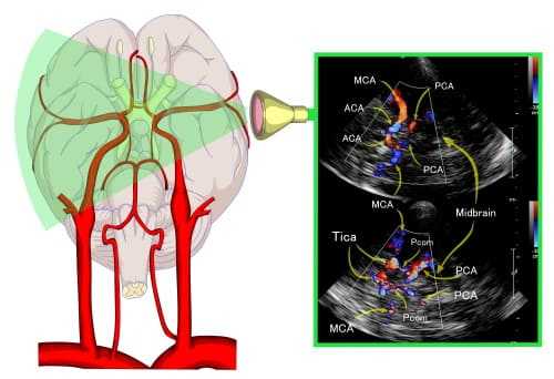 Допплерография внутренних артерий мозга