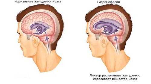 Желудочки мозга в норме и при гидроцефалии
