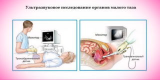 Застой крови в малом тазу у женщин и мужчин: симптомы, лечение, причины