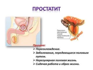 Простатит и причины его появления