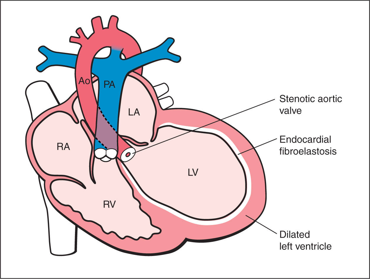 Сердечный стеноз. Врожденный клапанный стеноз аорты. Врожденный стеноз аортального клапана. ВПС стеноз аорты гемодинамика. Врожденный стеноз клапанов сердца.