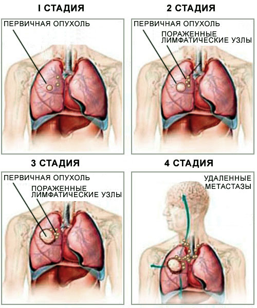 Как умирают от рака: все про больных раком перед смертью