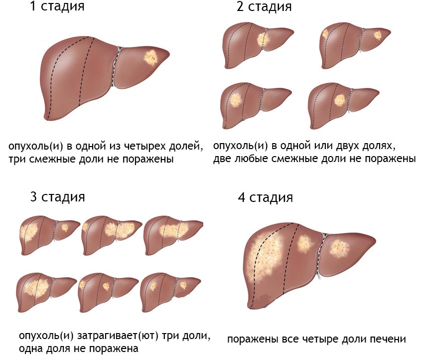 Как умирают от рака: все про больных раком перед смертью