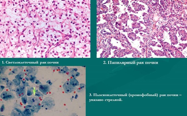 Светлоклеточный рак почки: подробный разбор заболевания