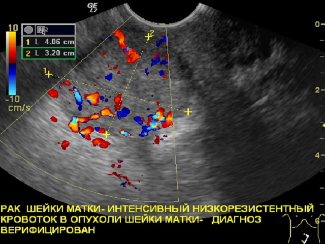 УЗИ: можно ли увидеть при исследовании рак шейки матки