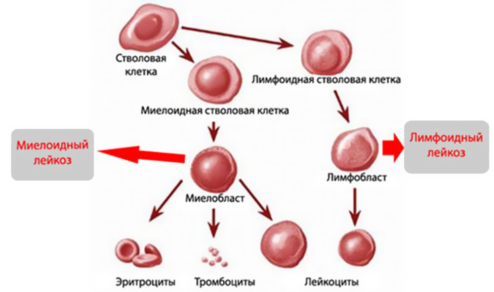 Лейкоз: коды в МКБ 10 – C91 и C92 – подгруппы и описание внутри