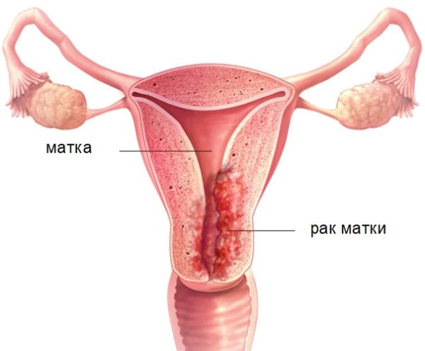 Рак матки