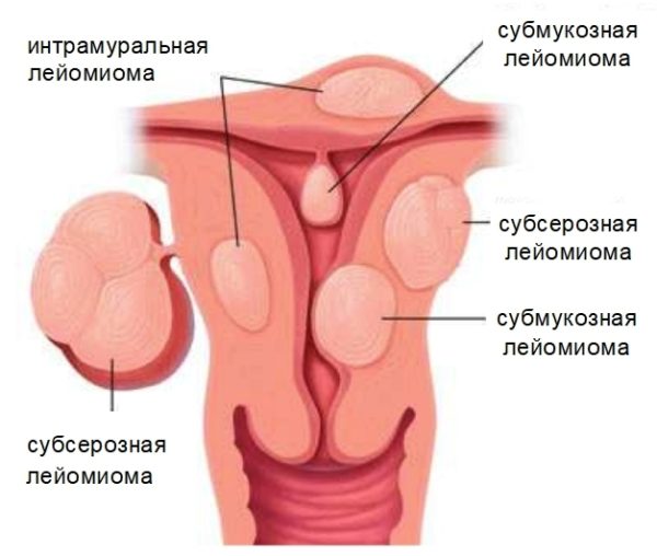 Разновидности лейомиом матки