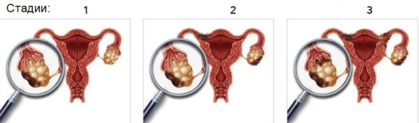 Стадии развития рака яичника