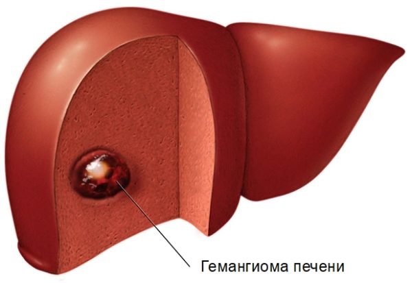 Ангиома печени