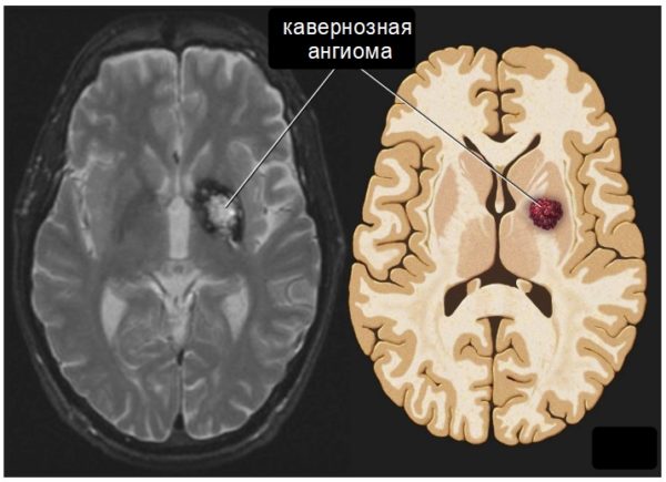 Кавернозная ангиома