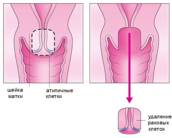 Удаление шейки матки