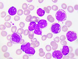 Клетки крови при миелолейкозе