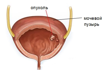 Опухоль в мочевом пузыре