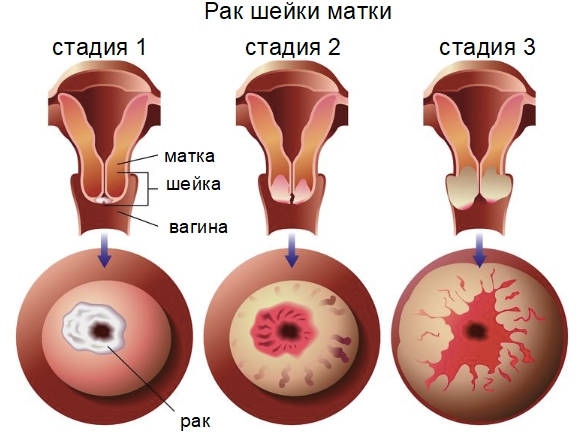 Рак шейки матки