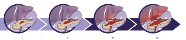 Стадии рака поджелудочной железы