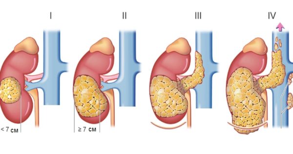 Стадии рака почки