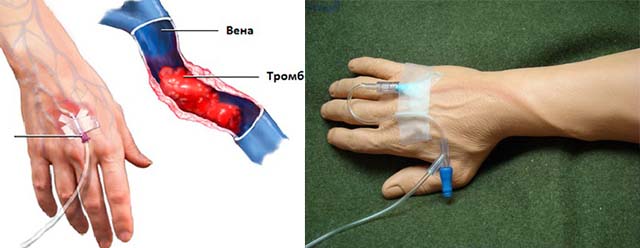 Флебит от катетера
