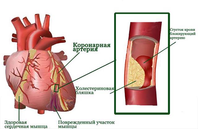 Холестериновая бляшка 