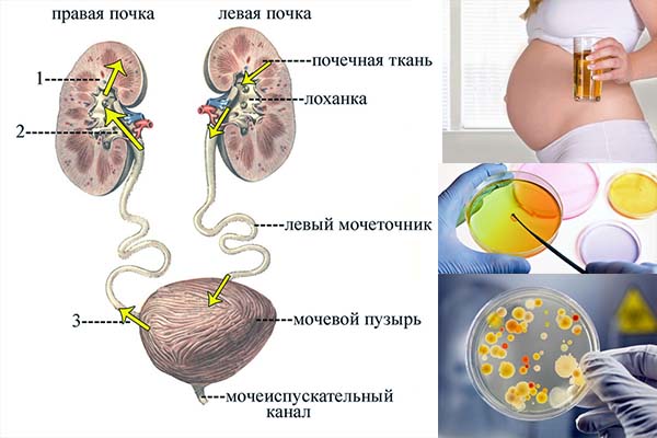 Бессимптомная бактериурия