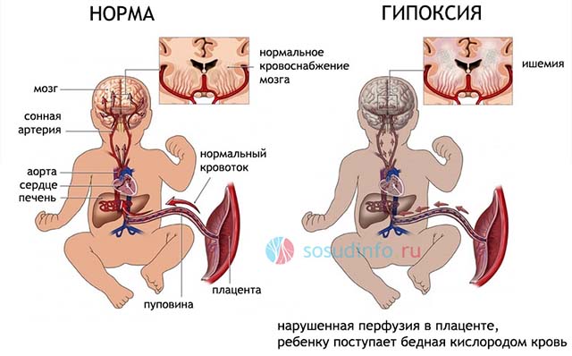 Кислородное голодание плода